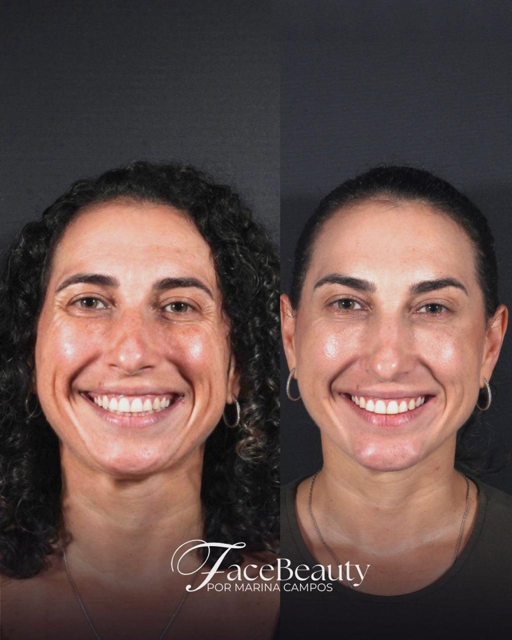 Antes e depois — Skinbooster e luminosidade