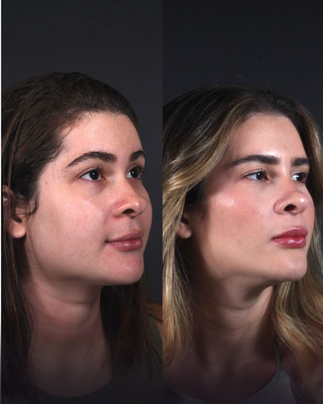 Antes e depois — Harmonização facial