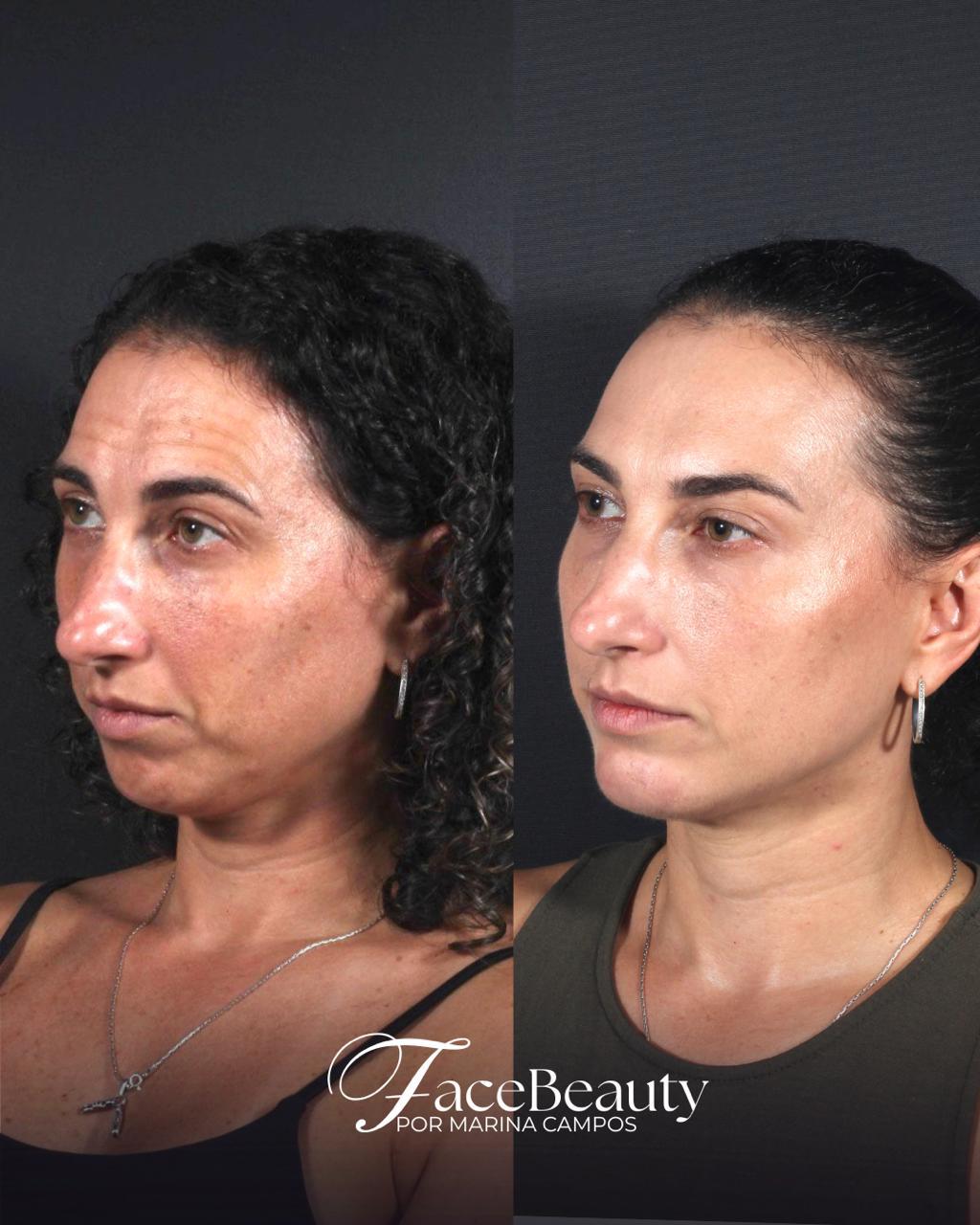 Antes e depois — Rejuvenescimento integral