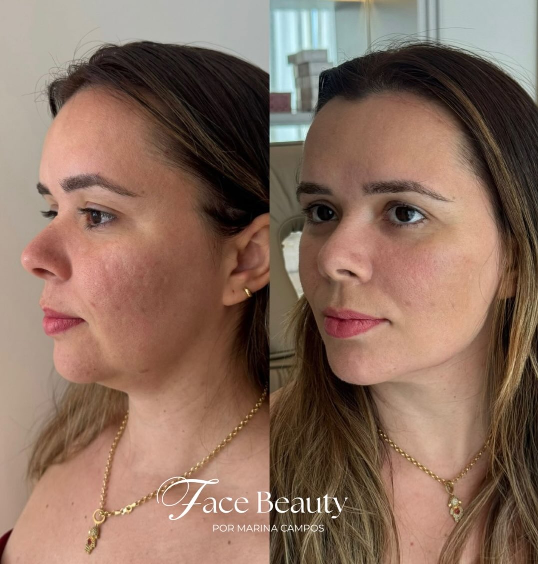 Antes e depois — Definição de mandíbula