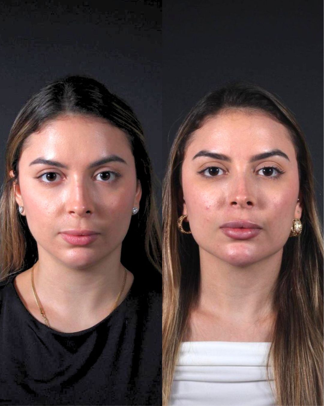 Antes e depois — Harmonização e contorno do rosto